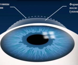 Лазерная коррекция зрения — что нужно знать?